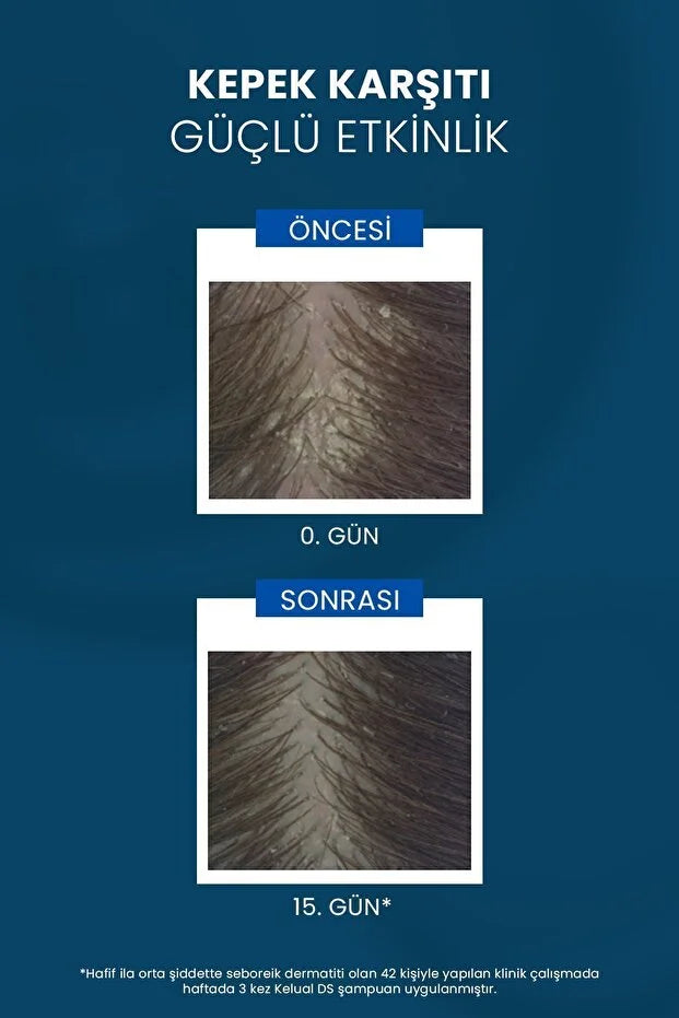 Ducray Kelual Ds Shampoo Kepeğe Karşi Şampuan 100ml